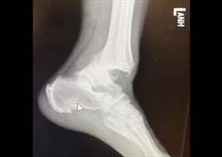 That’s How We Roll: Ankle Injuries in Skydiving