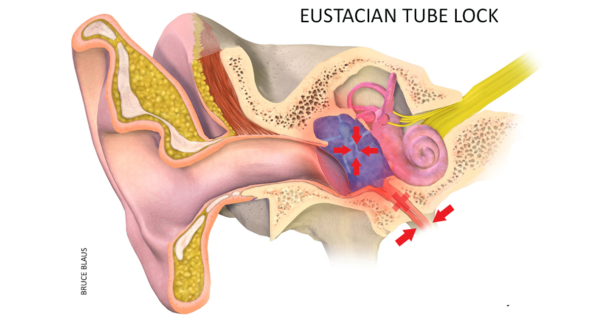 A Better Way to Treat Barotrauma